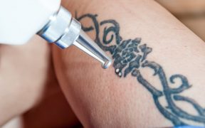 Laserowe usuwanie tatuazy